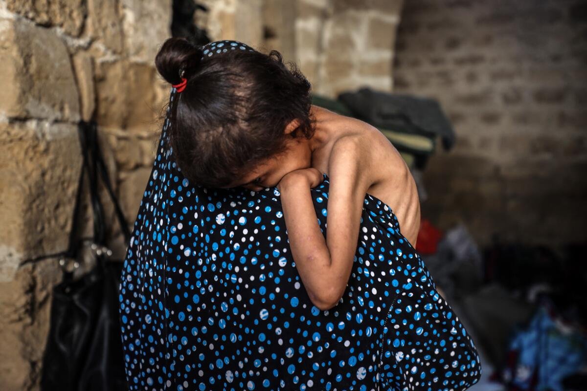 Islam Hajjaj holds her 6-year-old daughter Najwa, who suffers from malnutrition