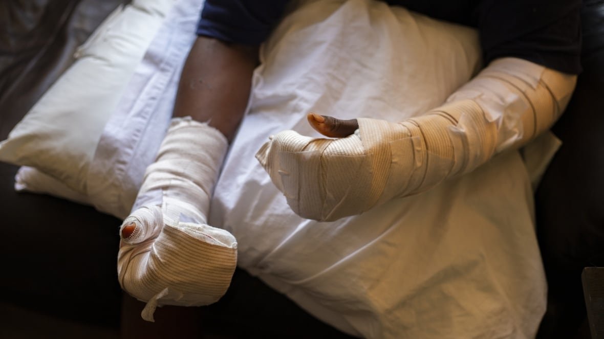 A boy holds two hands covered in bandages on a pillow.